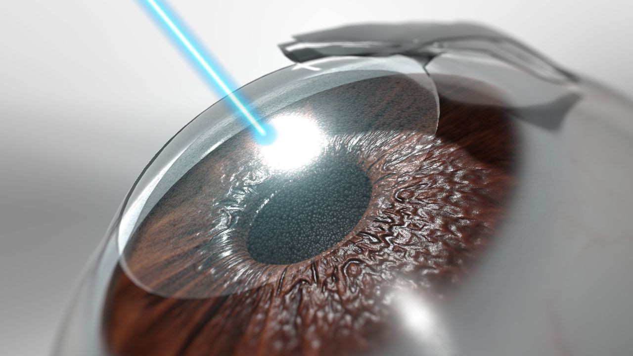 LASIK